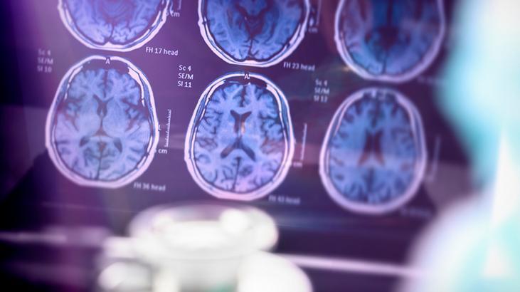 SAĞLIK HABERLERİ: ALZHEIMER HASTALIĞINI ERKEN TEŞHİS EDEN KAN TESTİ